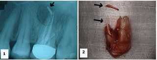 periapical pathology radiolucency endodontics root canal abscess failure infection swelling