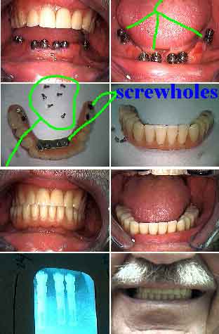 radiographs x-rays xrays titanium dental implants implantology, artificial tooth roots xray x-ray