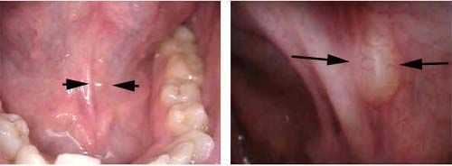 ranula mucocele blocked salivary gland  Oral Pathology Cyst Dental symptoms treatment disease cure