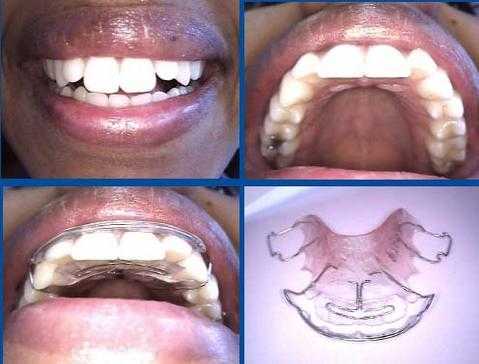 retainer for teeth before and after