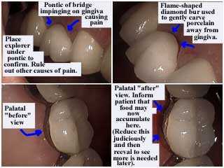 dental tooth bridge complications, gingival gum impingement, blanching, periodontics