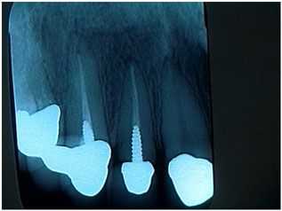 Crown, Post and Core, Recementation,  Case Presentation, Patient Management,  Dentistry Complication