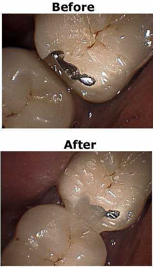 Repair of fractured porcelain dental crown Fracture fix etch silane primer bond bonding