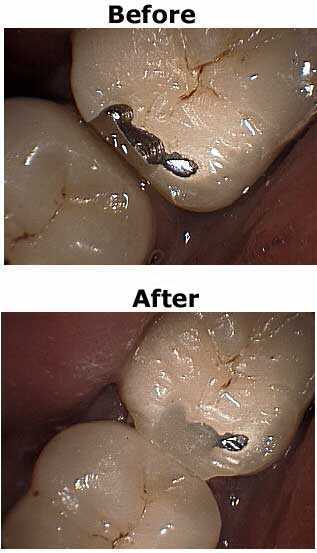 Porcelain Crown Repair, Dental Crown Fracture, Silane Primer Bonding, porcelain etchant 