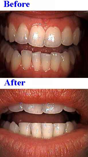 crowding, crooked, reshaping, recontouring, incisal, occlusal, adjustment, sculpting
