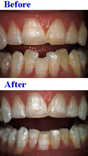 reshaping teeth, shorten tooth length, shape, instant orthodontics, cosmetic dental bonding