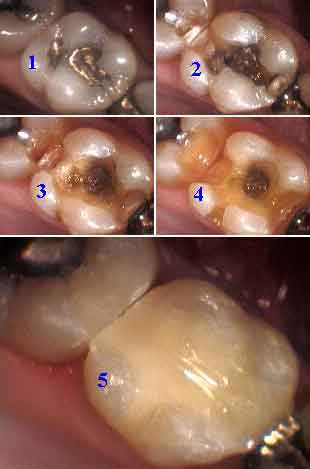 dental bonding technique, All Bond 2, Bis-fil, operative dentistry, dual cured catalyst, bonded