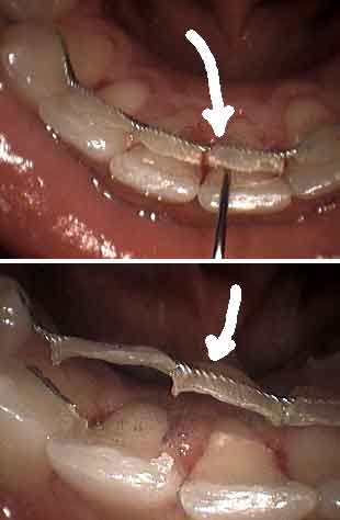 retainer teeth braces, fixed lingual bonded wire orthodontic retention