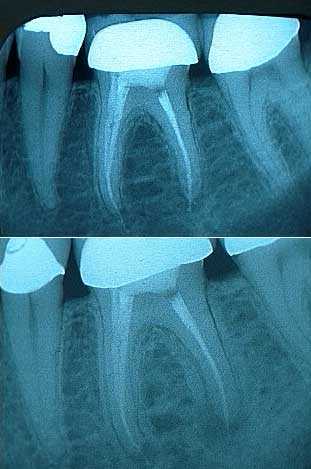 retreatment x-ray root canal xray failure apical radiolucency radiographs teeth x-rays endodontics