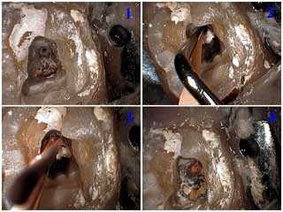 access endodontic obturation root canal filling lateral condensation, gutta percha, apex terminus