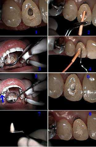 endodontist, root canal filling endodontics obturation drilling through dental crowns, gutta percha condensation