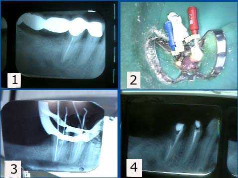 endodontist, root canal filling endodontics obturation