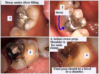silver filling tooth decay cavity, teeth cavities, dental caries, carious lesions, recurring