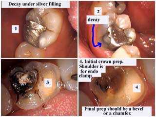 recurrent tooth decay crown cavity caries endodontic clamp bevel chamfer finish line