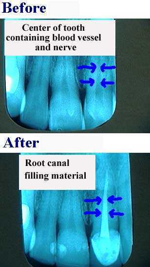 root canal tooth pain teeth mouth dental endodontics endodontist periapical infection pathology