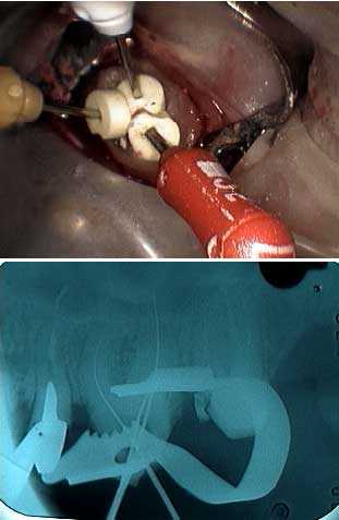 cleaning shaping root canal, molar endodontics, tooth lengths, endo files measurement endodontist