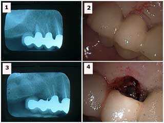 infection of tooth oral mouth dental root resection hemisection extraction abscess infected gums