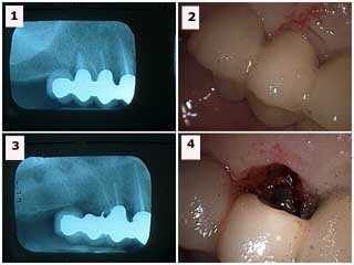 root resection tooth extraction dental implants removal pull teeth dental Oral Surgery Surgeon dentoalveolar