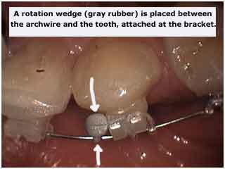 rotation wedge, fixed orthodontics elastics, braces, rotation, orthodontist
