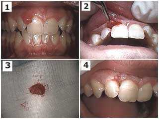 pyogenic granuloma, fibroma, papilla hyperplasia, gum growing, cutting gums, periodontal surgery