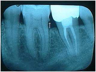 infected plaque, calculus, gingivitis, gum disease, periodontitis, periodontal, x-ray, radiograph