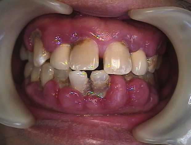 gross mouth diseases