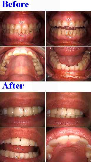 Sculpting, porcelain tooth reshaping irregular teeth, incisal adjustment recontouring