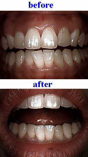 orthodontics, without teeth braces, no braces, straighten teeth without braces, cosmetic dentistry