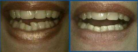 sculpting reshaping teeth incisal adjustment occlusal bite teeth dental occlusion malocclusion