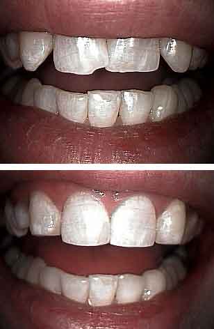 how to close teeth spaces, cosmetic composite resin bonding for fang teeth, procedure