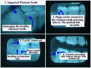 impacted wisdom tooth impaction decay cavity third 3rd molar teeth cavities dental caries carious