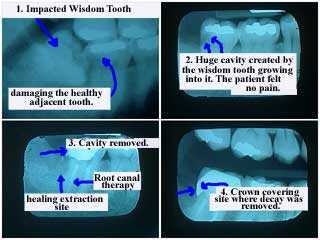 extract pull take out tooth teeth removal extraction xrays x-ray radiographs dental caries cavities