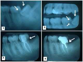 impacted wisdom tooth teeth extractions third 3rd molar impactions partial bony cavity decay pain