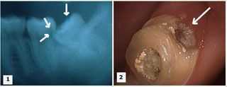 Eruption of teeth, tooth position, wisdom tooth extraction, second molar damage, explain reason