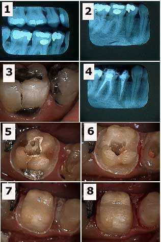 root canal pain, endodontics, crown, cap, build-up, core, chief complaint, diagnosis, exam