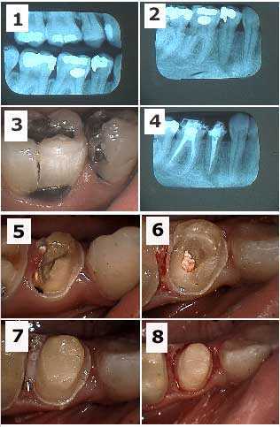 sequence root canal endodontics sequencing dental treatment plan order procedure list strategy