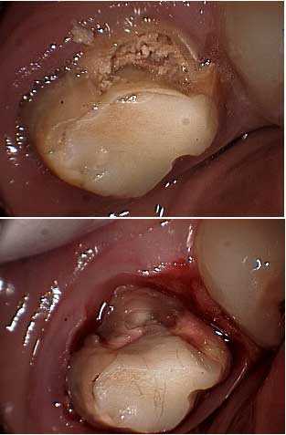 Osseous Surgery, periodontal flap gum surgery, jaw bone disease osseous reduction caries cavity