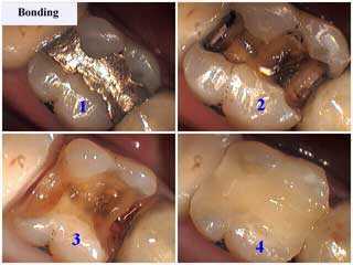 silver filling removal, operative dentistry, bonding restorations, tooth white fillings, teeth bond