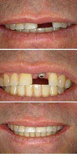 single tooth dental implant, dental crown tooth implant supported, Dr. Neal Gittleman