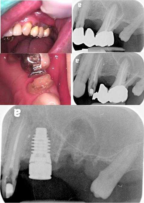 single tooth dental implant, titanium artificial tooth replacement, treatment sequencing