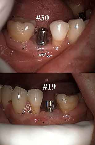 single tooth implants crowns caps, cemented, artificial tooth roots, tooth replacement