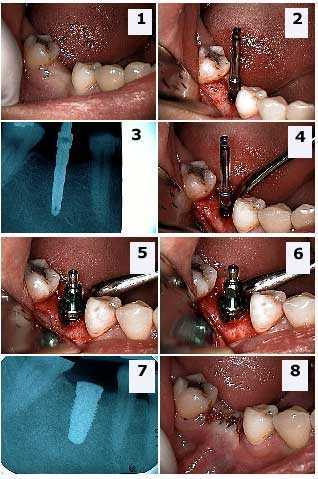 Single Tooth dental implant, X-ray, Inferior Alveolar Nerve, oral surgery Implant Placement