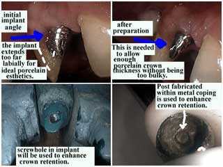 dental implants complications problems, tooth implant, porcelain dental crown cap aesthetics