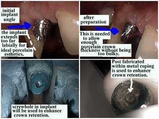 single tooth implants, fixed, caps, crowns, bridges, single tooth, screw hole, porcelain thickness