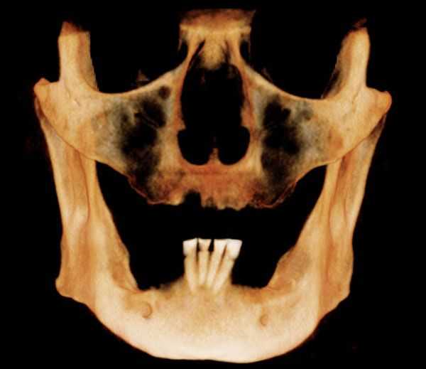 A CT scan shows the volume of bone for dental implants, CAT, lower jaw, mandible, implant dentistry
