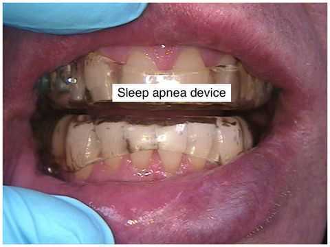 Sleep Apnea occlusal appliance, Mandibular Advancement Device, MAD