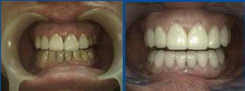 NY smile makeovers shows esthetic dentistry using Porcelain veneers laminates to change tooth color
