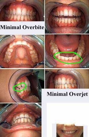 tooth buck teeth perfect overbite, overjet, smile analysis, over bite, over jet dental occlusion