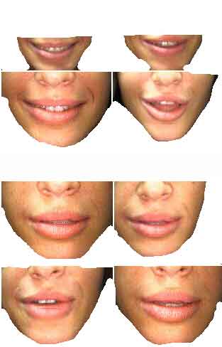 lip line analysis, smile, smiling, speaking, contours, face, type depth line symmetry, tooth gumline