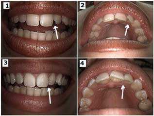 front tooth rotated, without teeth braces, no braces, without braces, cosmetic dentistry